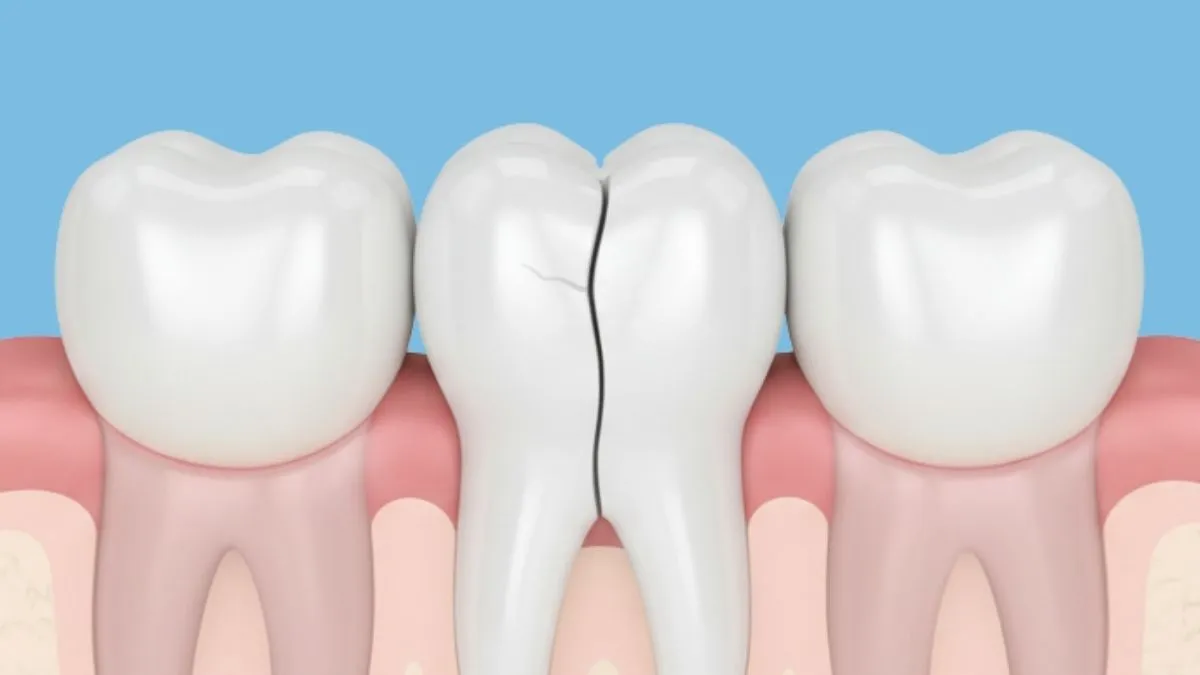 Broken Tooth or Cracked Tooth